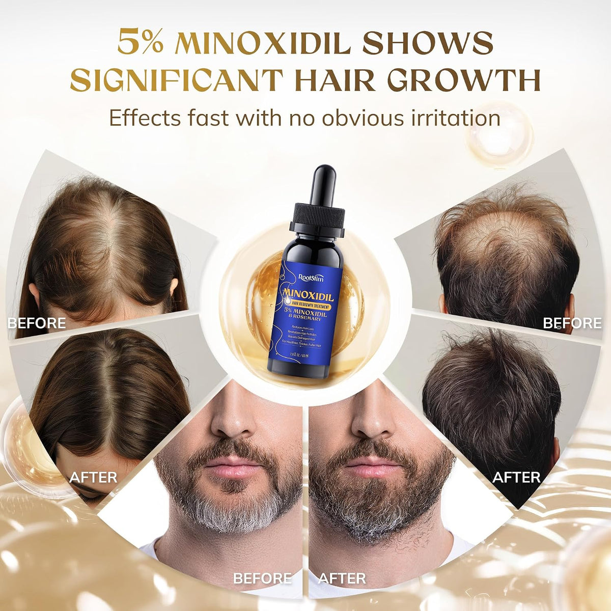 5% Minoxidil Hair Growth Serum for Men Women, with Rosemary &Biotin, Hair Loss Treatment Extract Support Thicker Fuller Healthier Hair Texture - 2 Fl Oz